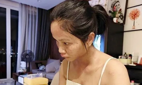 Hoa hậu H'hen Niê tiết lộ căn bệnh mà cô mắc phải sau sinh