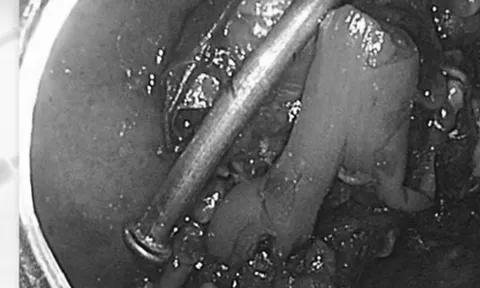 Bé trai 8 tuổi nghịch dại, bác sĩ kinh ngạc phát hiện thứ "đáng sợ" bên trong bụng