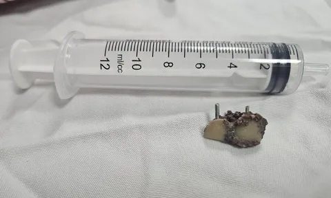 Bỗng dưng mất 2 chiếc răng, 20 năm sau bác sĩ phát hiện trong... phổi