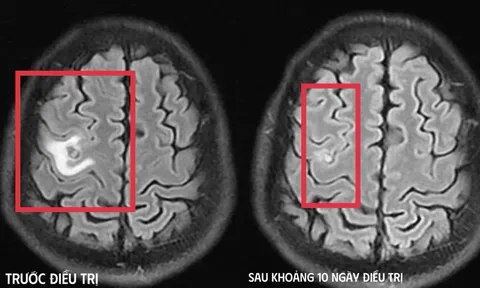 Cơn co giật bất thường hé lộ “vị khách lạ” ký sinh trong não