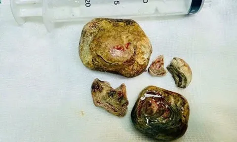 Người đàn ông 43 tuổi "bụng cứng như đá", bác sĩ phát hiện bí mật "đáng sợ"