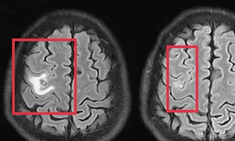 Người đàn ông 39 tuổi đau đầu, bác sĩ phát hiện thứ "đáng sợ" bên trong