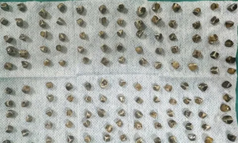 Đau bụng đi khám, người phụ nữ 40 tuổi sốc khi bác sĩ gắp ra thứ "đáng sợ" bên trong