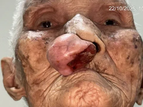 Phẫu thuật cho cụ bà gần 100 tuổi sau 30 năm sống chung với khối u trên mặt