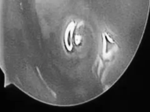 Bé trai hơn 2 tuổi chảy mũi hàng ngày, bác sĩ phát hiện ra "bí mật" đáng sợ