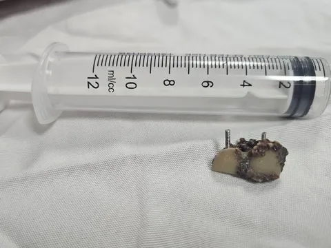 Bỗng dưng mất 2 chiếc răng, 20 năm sau bác sĩ phát hiện trong... phổi