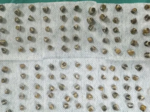 Đau bụng đi khám, người phụ nữ 40 tuổi sốc khi bác sĩ gắp ra thứ "đáng sợ" bên trong